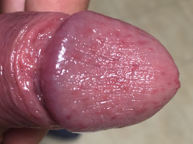 Heat Rash On Penis 62